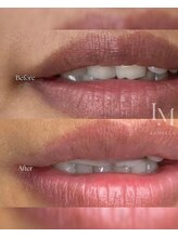 エ リンダ(E- LINDA)/ルメラ　ビフォーアフター