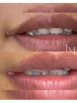 エ リンダ(E- LINDA)/ルメラ　ビフォーアフター