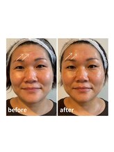 ウィッシュプロサロンケー(WISHpro salon K)/1回の効果！深いおでこのシワも