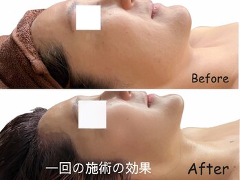 ドクターマジックタッチ(Dr.MAGIC TOUCH)/脂肪分解フェイシャルケア