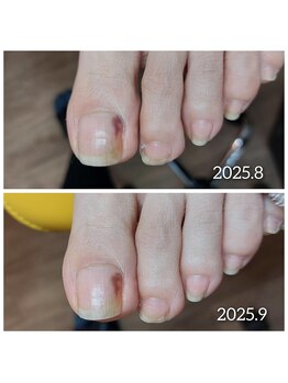 【爪下の内出血】