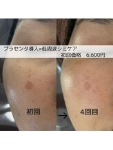 アリス 心斎橋店(alice)/シミケア×プラセンタ