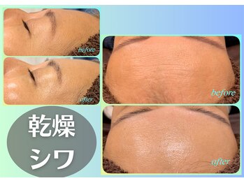 ラヴェンナサロン トウキョウ(Ravenna Salon Tokyo)/シワ対策!