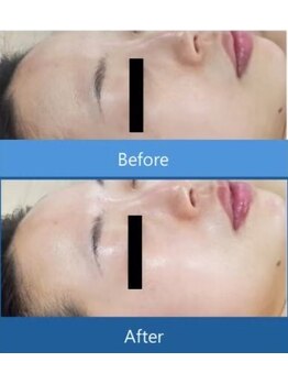 リズ ボーテ/ダクトピール