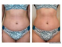 リハーツ(RE;heartz)/★－４℃脂肪冷却導入★