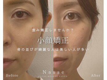 ナッセ(Nasse)/小顔美骨矯正/小顔矯正