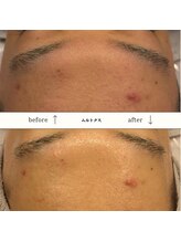 ビーエヌ エステティックアンドスパ(BN Esthetic&Spa)/20代メンズムルトクス