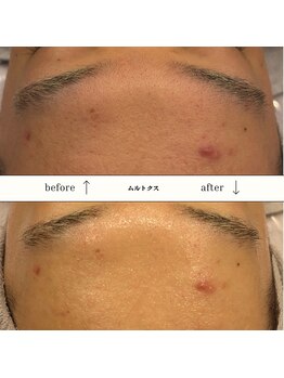 ビーエヌ エステティックアンドスパ(BN Esthetic&Spa)/20代メンズムルトクス
