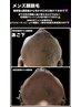 【フォトRFメンズ脱毛】顔　90分
