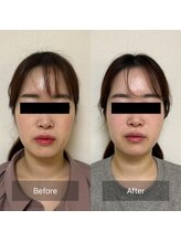 リリー(Lily)/ビフォーアフター