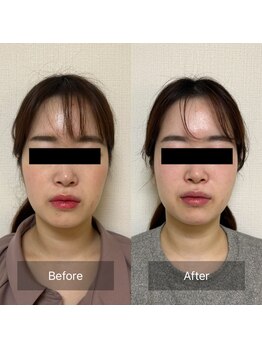 リリー(Lily)/ビフォーアフター