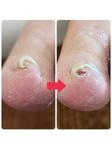 北区天神橋巻き爪センター/巻き爪