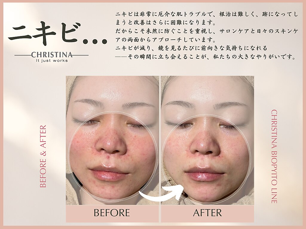 中津駅で毛穴洗浄・毛穴吸引が人気のエステサロン｜ホットペッパー