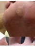 フット角質ケア60分パック無  足裏のタコやうおの目でお悩みの方!　