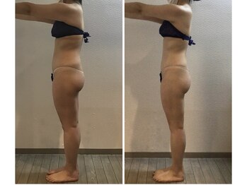 カリス/全身10回ビフォーアフター