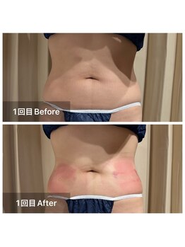 リノリー 仙台荒井店(rinory)/脂肪冷却痩身