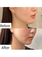 ヒカリエステ 六本木(HIKARI ESTHE)/切らない小顔リフト