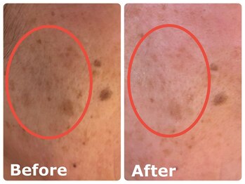 スイ 昭島店(Sui)/ホワイトスノーピール/シミ/美白