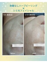 ベルクラージュ(Belle Courage)/30代　シミケア