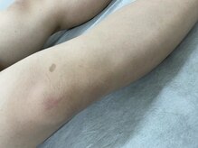 ナノハナ/鹿沼市全身脱毛美容室ナノハナ