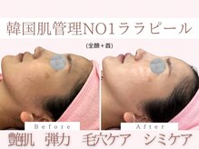 Cスキンケアクリニック 麻布店/ララピールBeforeAfter#艶肌