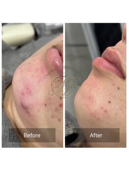 ドクターエイチ 麻布十番店(Doctor.H)/本気のにきびケア♪