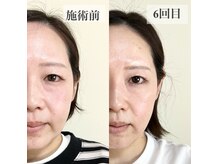 ファソ ブロウアンドアイズ(fasol)の雰囲気（岡山県初！美顔筋テラボーラー/たるみケア、ハリ弾力UP/小顔）