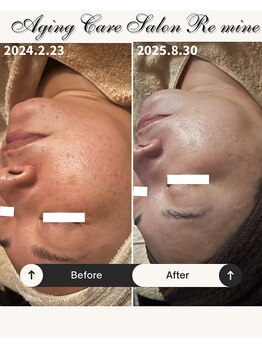 リマイン(Re mine)/お肌の悩み改善へ