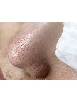 毛穴ケアをしたい