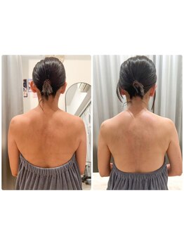 二の腕・ハミ肉ケアをしたい