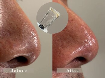 ビム(BIM)/フェイシャル/毛穴洗浄/東大和市