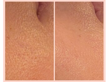 ワイズ(Y's)/水素導入＋水素パック