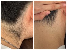 シロ(Shiro)/うなじのデザイン脱毛