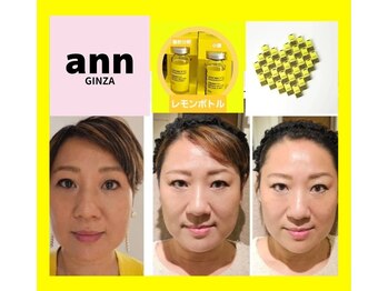 アン 銀座(ann)/レモンボトル3回目で別人級