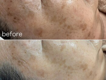 ジャスミン(Jasmine)/メラトニンへアプローチ！肌改善