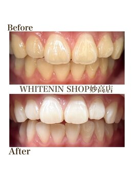 ホワイトニングショップ 妙高店(whiteningshop)/お顔全体の印象も明るく!