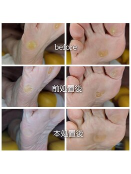 爪切り屋 足楽/【足裏の硬いタコ】