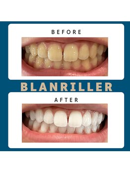 ブランリエ 天王寺阿倍野店(BLANRILLER)/セルフホワイトニング