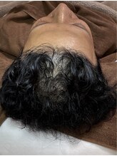 アマリージョヒラソル/Lit ヒト羊膜幹細胞