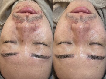 ビーマジック(Be Magic)/メンズ眉/メンズ/眉サロン/毛穴