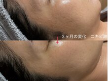トモニ(TOMONI)/ダクトピール　3ヶ月の変化