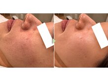 エピシア(Epicia)の雰囲気（ララピールの効果、毛穴引き締まり、ざらつき改善の一例です☆）