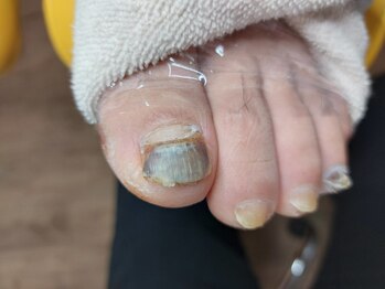 爪切り屋 足楽/変色・肥厚爪★【before】