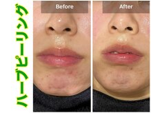 ブレア(Blair)/漢方ハーブピーリング