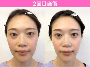 ナチュラルパーフェクトフェイス 新宿/2回目施術