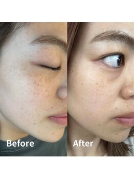 ギルドハナレ(GUILD HANARE)/"シミケア×プラズマ"