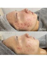 エレファンテブランコ(Elefante Blanco)/☆繰り返す赤ニキビ