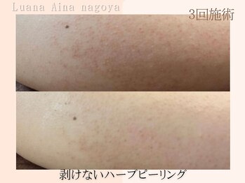 ノイエ(NOIE)/ハーブピーリング