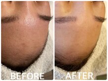 ハーブピーリング 恵比寿/インナードライ/くすみ/透明感