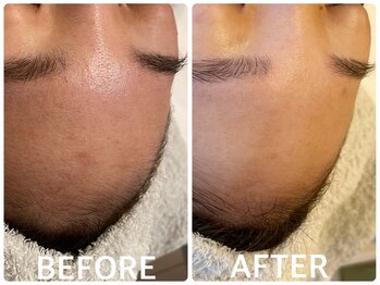 ハーブピーリング 恵比寿/インナードライ/くすみ/透明感